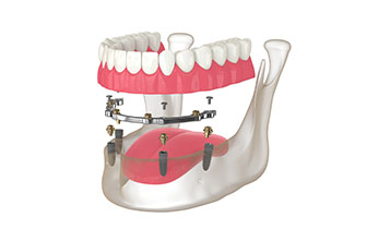Prothèses sur implants